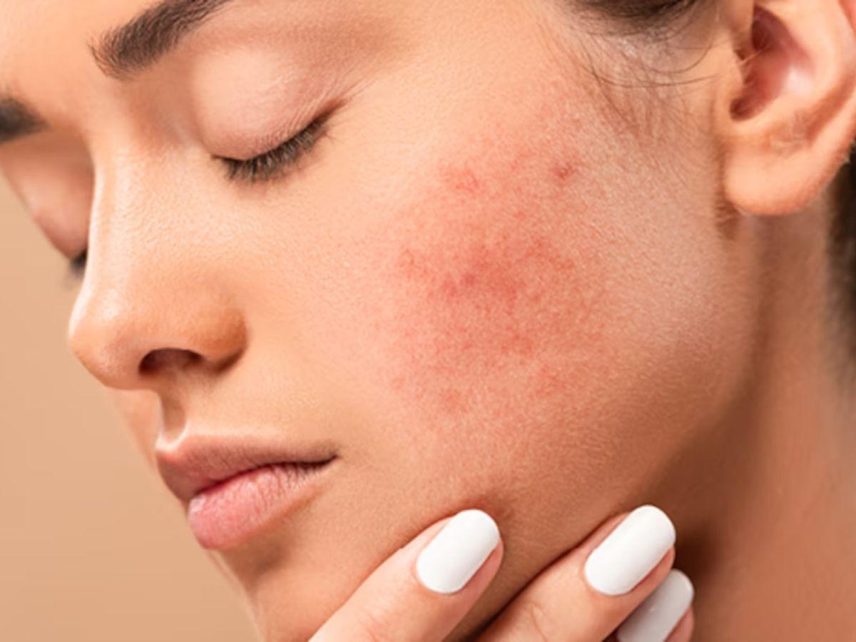 Da đỏ rát khi bị kích ứng