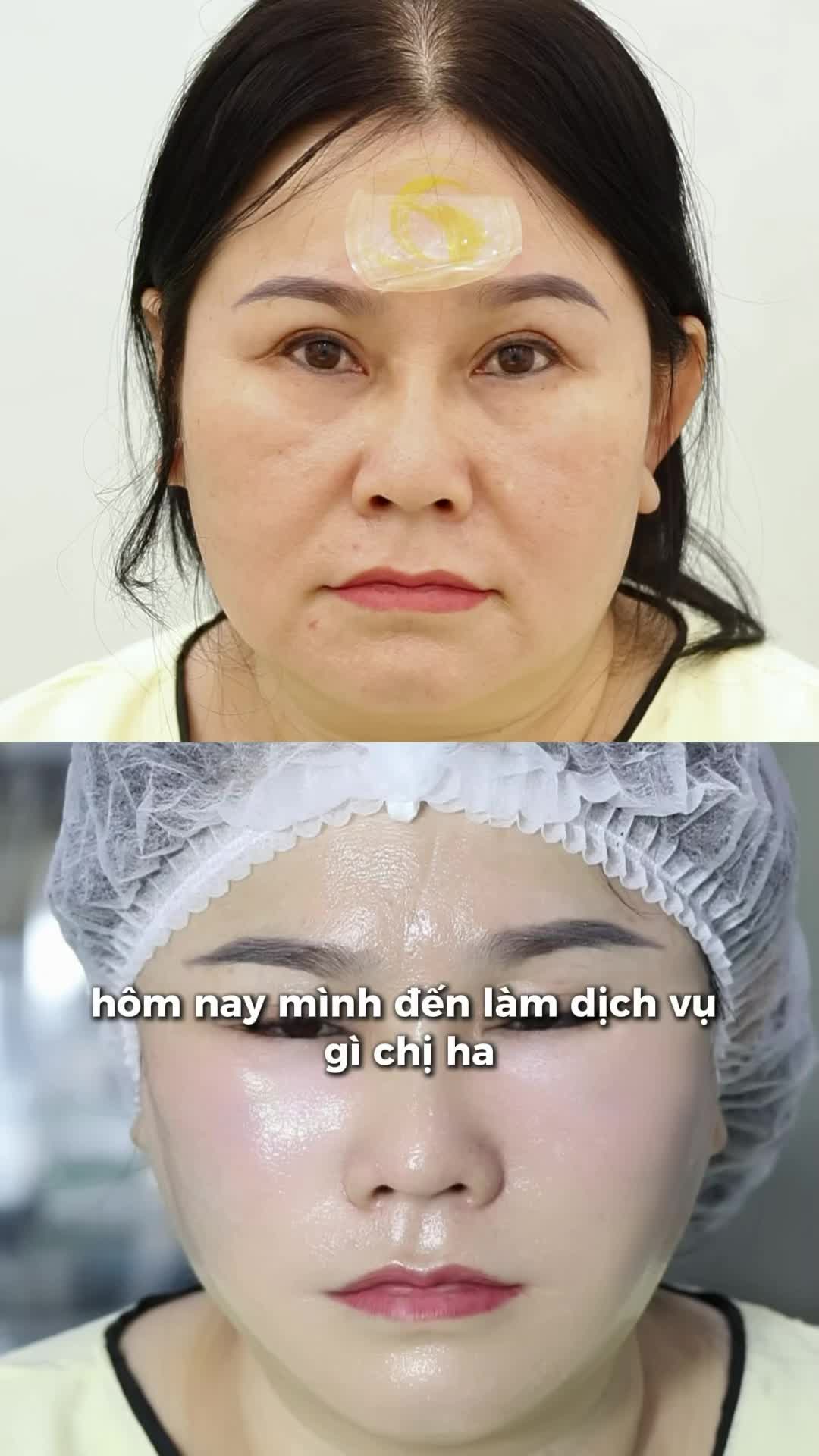Bác sĩ Hana Premium Beauty Center phân tích cấu trúc mặt trước khi độn sụn rãnh cười