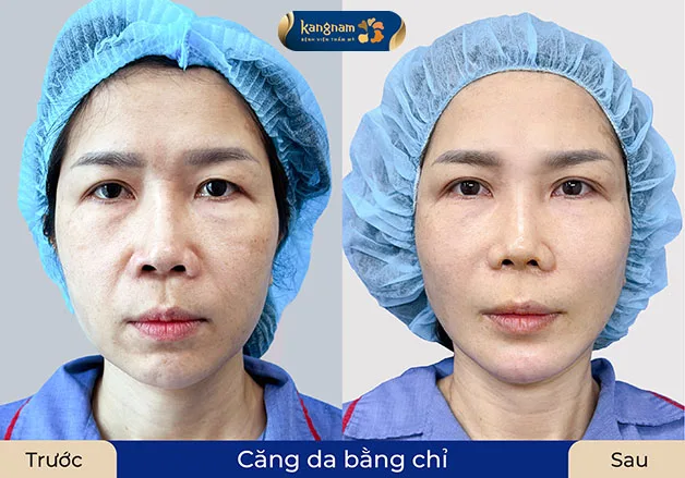 Bác sĩ đang thực hiện kỹ thuật luồn chỉ căng da mặt