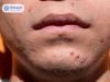 Minh họa kỹ thuật trẻ hóa da vùng mắt bằng phương pháp căng chỉ sinh học
