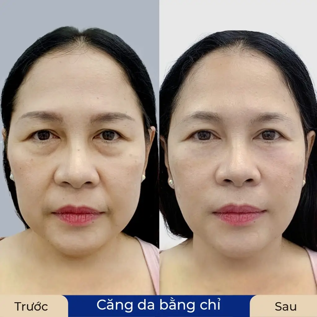 Quá trình chăm sóc da khoa học sau khi cắt chỉ giúp tối ưu hóa kết quả căng da mặt
