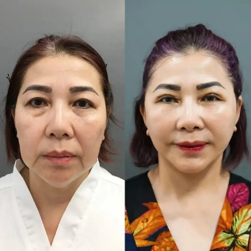 Bác sĩ kiểm tra vết thương sau phẫu thuật căng da mặt