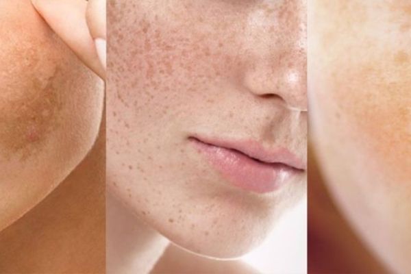 Các loại nám da thường gặp và phương pháp phối hợp NÁM – TRANEXAMIC ACID hiệu quả