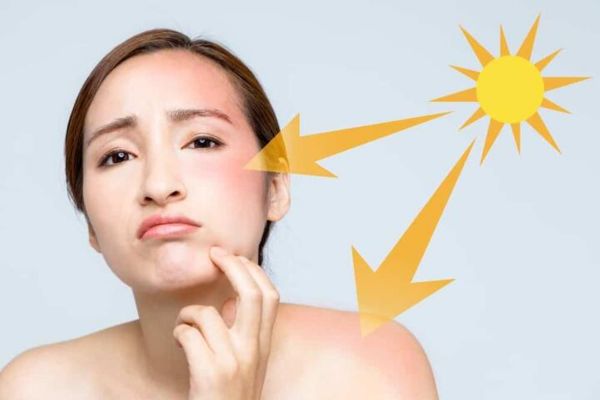 Phân tích chi tiết nguyên nhân gây nám da liên quan đến yếu tố mạch máu