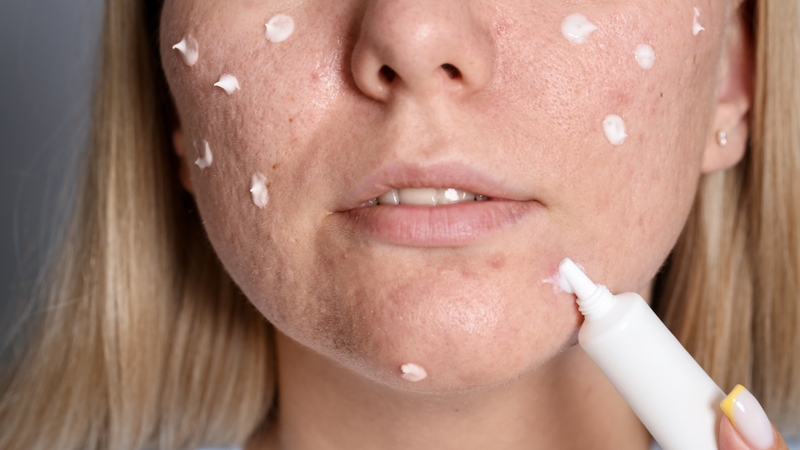 Chăm sóc da mụn thông minh giúp ngăn ngừa biến chứng và tối ưu ngân sách skincare