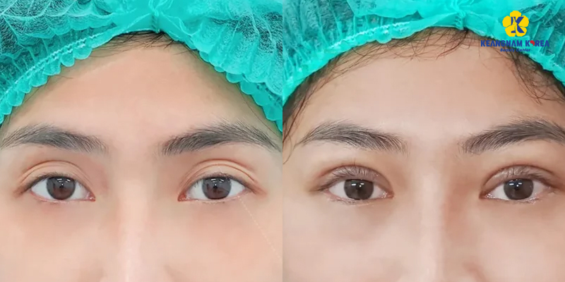 Bác sĩ chuyên khoa đang thực hiện phẫu thuật sửa mí lỗi tại Hana Premium Beauty Center