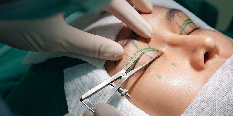 Hình ảnh minh họa các kỹ thuật chuyên sâu được áp dụng để khắc phục tình trạng sửa mí hỏng