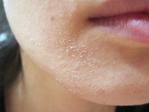 Da nổi mẩn và bong tróc khi bắt đầu quy trình dưỡng da 6-12 tuần với hoạt chất mạnh.