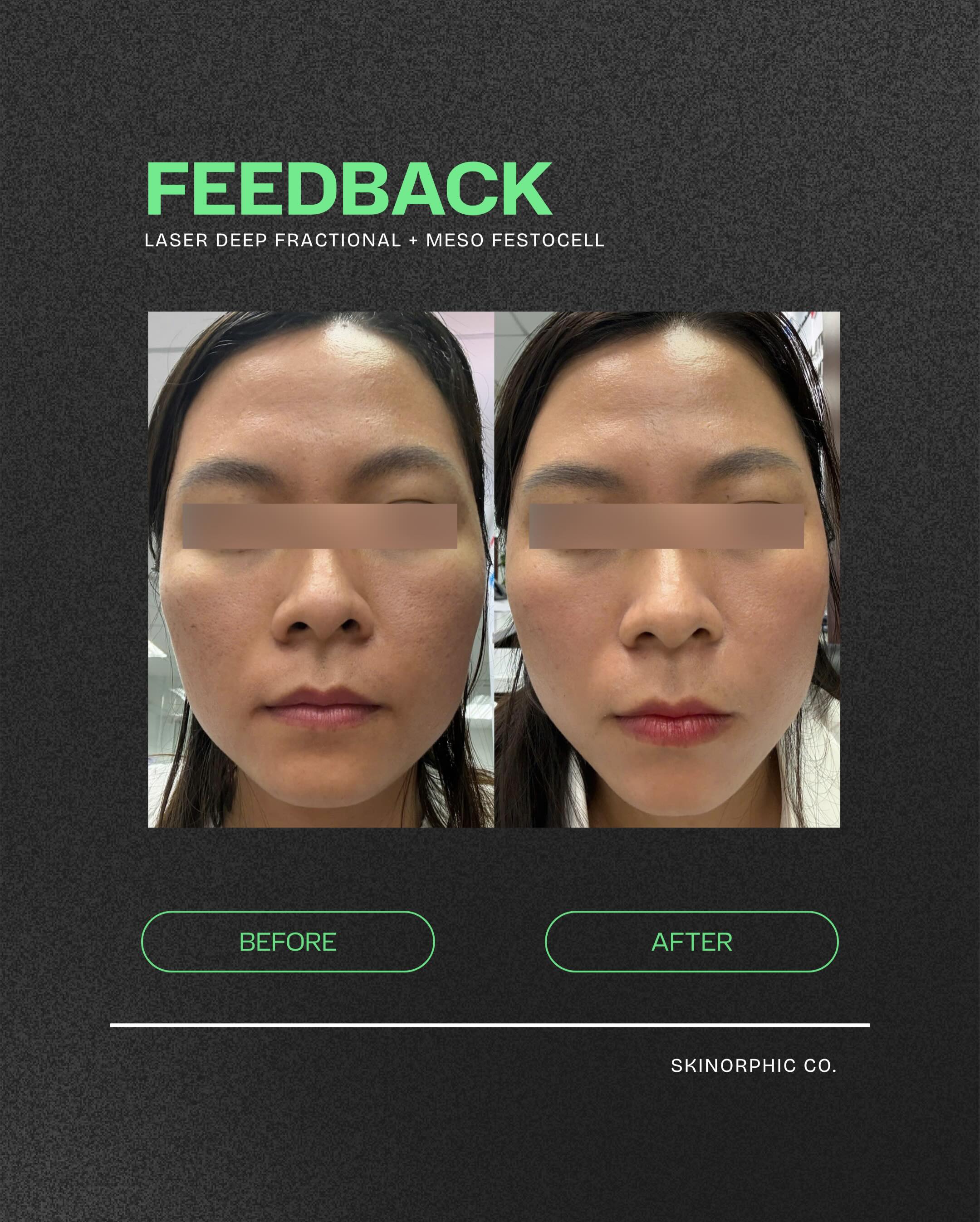 Bác sĩ Hana Premium Beauty Center thực hiện bắn Hifu và tiêm Botox
