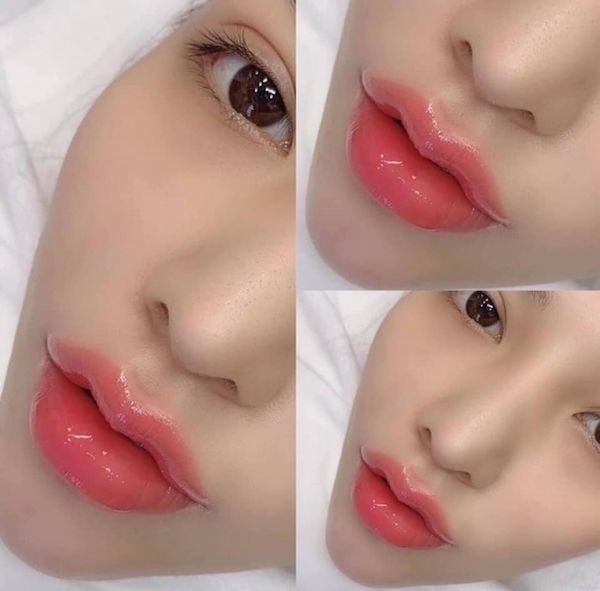 So sánh kỹ thuật tiêm meso và filler để làm đẹp da và tạo hình khuôn mặt
