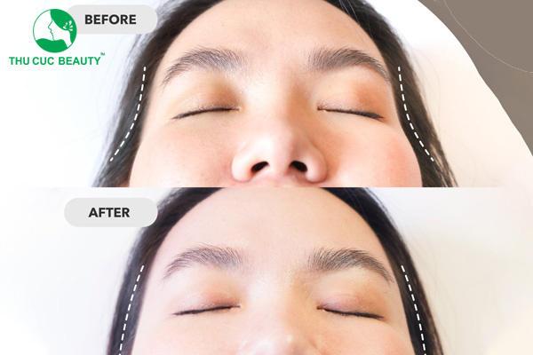 Các dấu hiệu cho thấy cần tháo sụn thái dương hỏng kịp thời