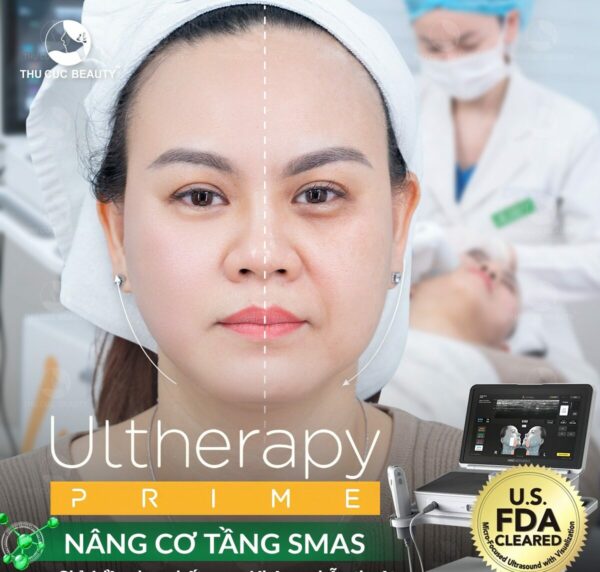 Sơ đồ kỹ thuật nâng cơ bằng chỉ tạo vector nâng đỡ vùng má giúp trẻ hóa tự nhiên.