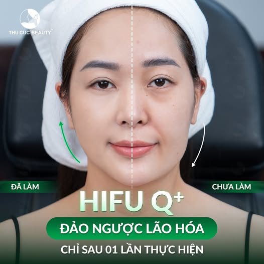 Quy trình căng chỉ chuẩn y khoa tại Hana Premium Beauty Center giúp xóa rãnh cười sâu.