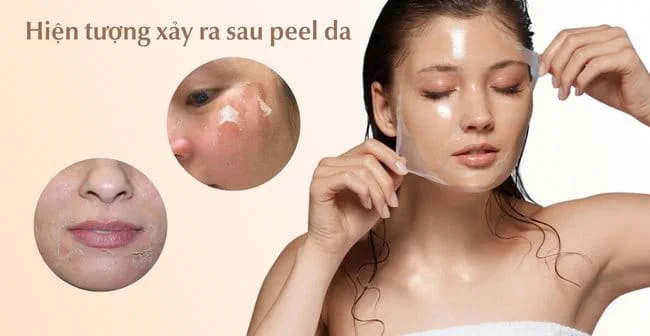 Hình ảnh minh họa quá trình phục hồi và chăm sóc da sau peel