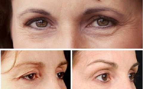 Sơ đồ vị trí che phủ của mí mắt giúp phân loại mức độ sụp mí