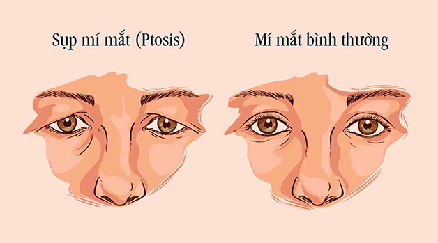 Sụp mí và lão hóa da vùng mắt cần được bác sĩ chuyên khoa thăm khám