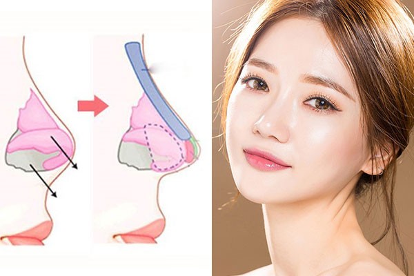 Hình ảnh minh họa nâng mũi bọc sụn duy trì kết quả lâu dài, thể hiện sự bền vững của phẫu thuật thẩm mỹ mũi