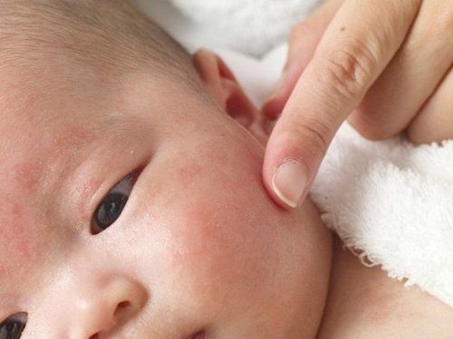 Quy trình chăm sóc da tối giản giúp trẻ kiểm soát da mụn vào mùa nóng an toàn