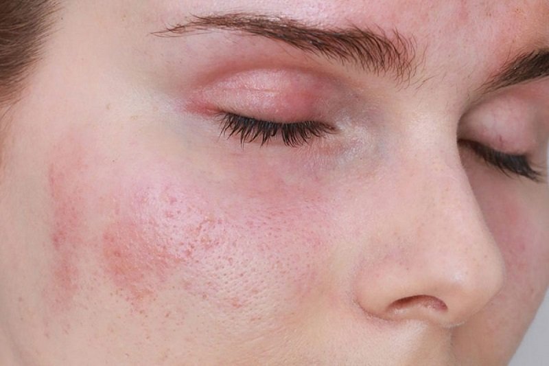 Da mẩn đỏ, khô, nóng rát - dấu hiệu da kích ứng cần phục hồi