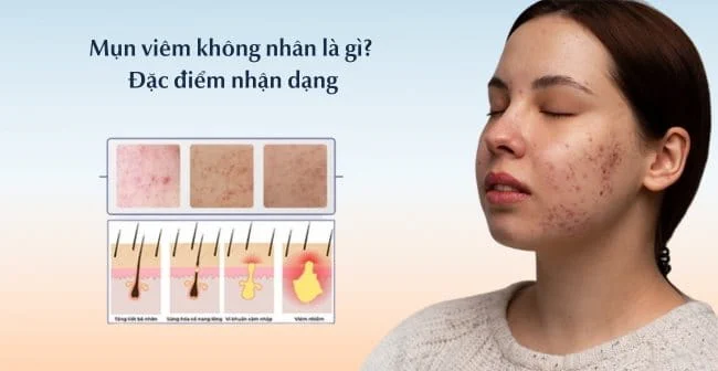 Tình trạng mụn viêm đỏ trên da nhạy cảm