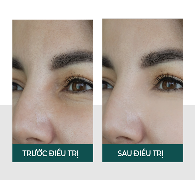Công nghệ Ultherapy được FDA công nhận cho thẩm mỹ nâng cơ mặt không xâm lấn