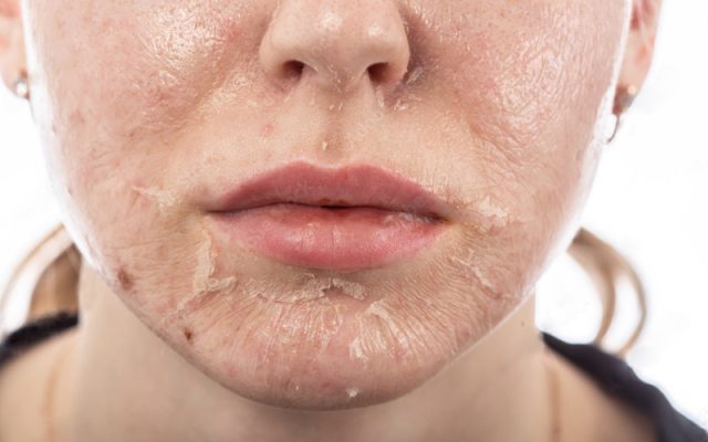 Minh họa các dấu hiệu da sau treatment cần phục hồi khẩn cấp