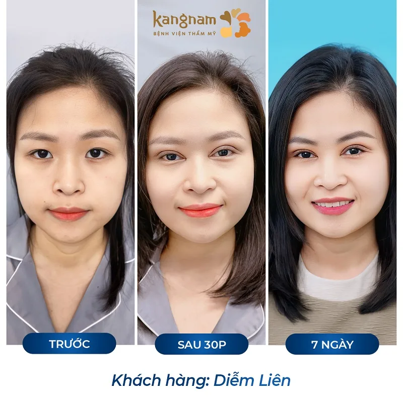 Bác sĩ hướng dẫn chăm sóc vùng mắt sau cắt mí