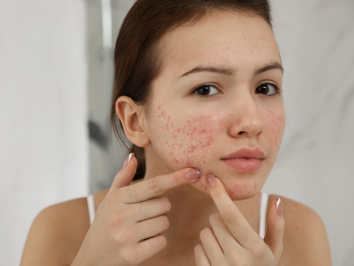 Làn da kích ứng cần phục hồi sau treatment.