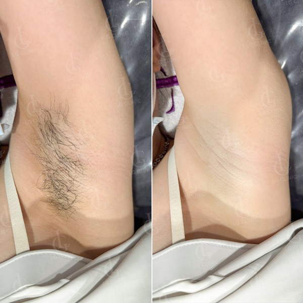 Quy trình thăm khám và triệt lông chuẩn y khoa tại Hana Premium Beauty Center giúp khách hàng đạt hiệu quả tối ưu.
