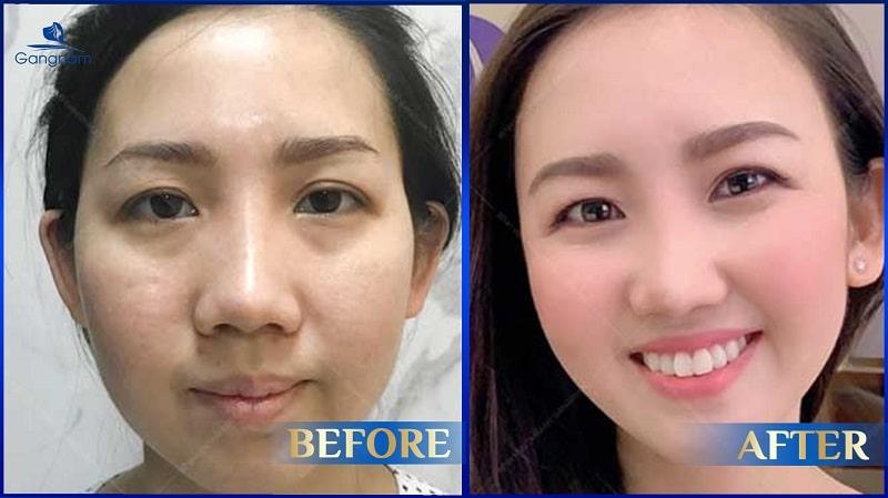 Quy trình tái tạo thái dương an toàn tại Hana Premium Beauty Center