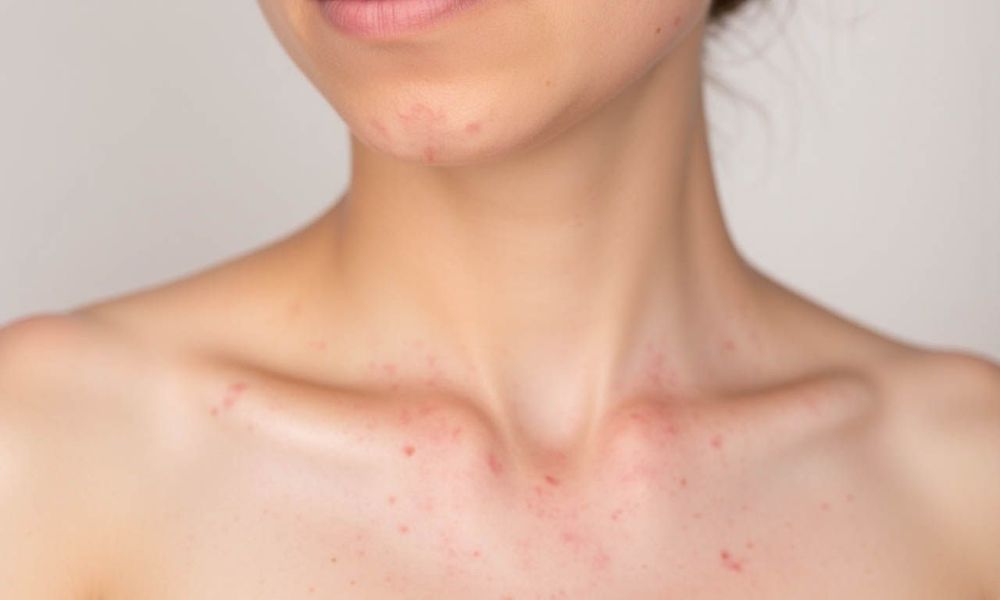 Mụn trứng cá và mẩn đỏ dễ trở nặng trên da nhạy cảm dưới tác động của nắng nóng và thời tiết khắc nghiệt.