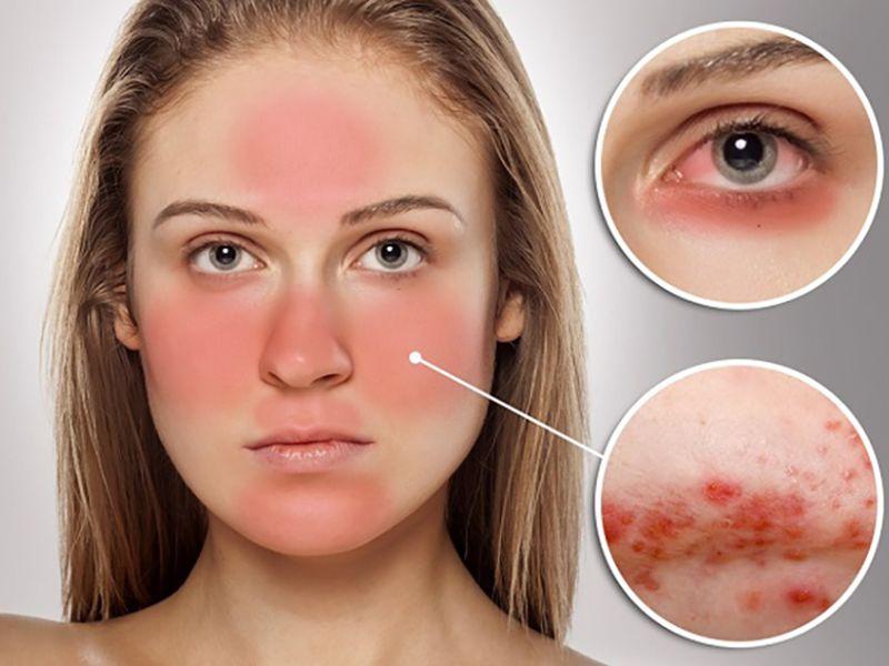 Làn da nhạy cảm dễ kích ứng với các thành phần mỹ phẩm, cần lộ trình phục hồi da nhạy cảm cẩn trọng.