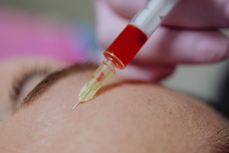 Minh họa kỹ thuật pha loãng độc tố Botulinum bằng kim tiêm siêu nhỏ trong quá trình TIÊM BOTOX