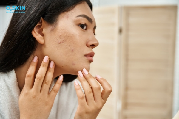 Làn da khỏe mạnh nhờ chế độ ăn uống khoa học và lối sống lành mạnh giúp kiểm soát mụn từ bên trong