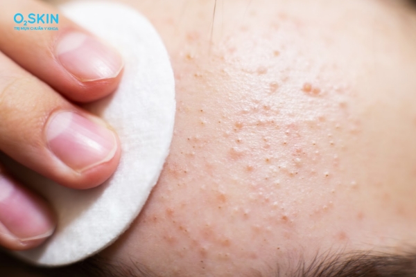 Các sản phẩm phục hồi da mụn nhạy cảm giúp xoa dịu kích ứng do nhiệt