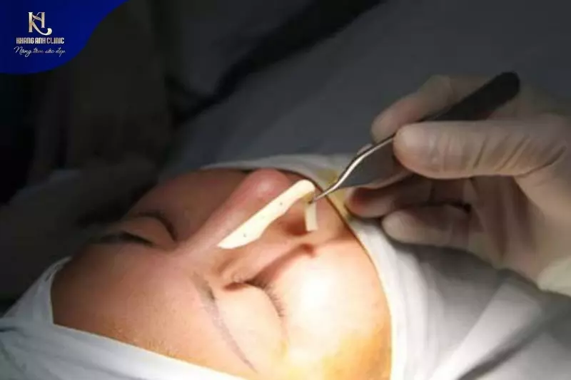 Sụn mũi nhân tạo cũ gây biến chứng đỏ da, lộ sóng cần được thăm khám và can thiệp sớm