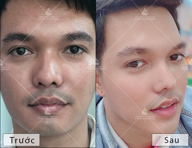 Khách hàng sau khi thực hiện phẫu thuật thẩm mỹ an toàn