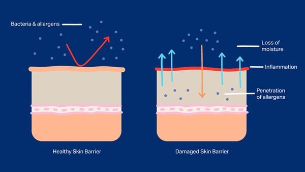 Minh họa hàng rào bảo vệ da bị suy yếu sau treatment