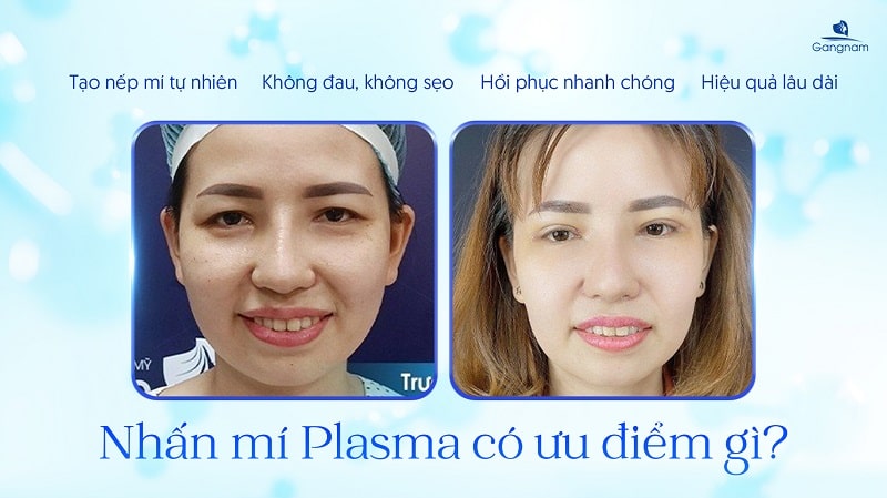 Minh họa kết quả duy trì lâu dài sau khi thực hiện nhấn mí Plasma