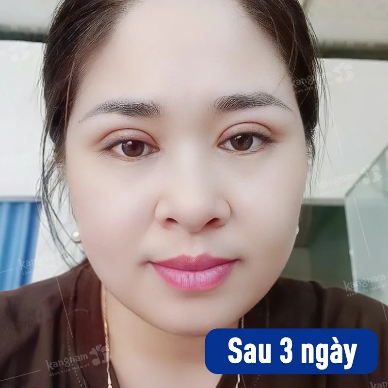 Quá trình hồi phục nếp mí sau phẫu thuật tại Hana Premium Beauty Center
