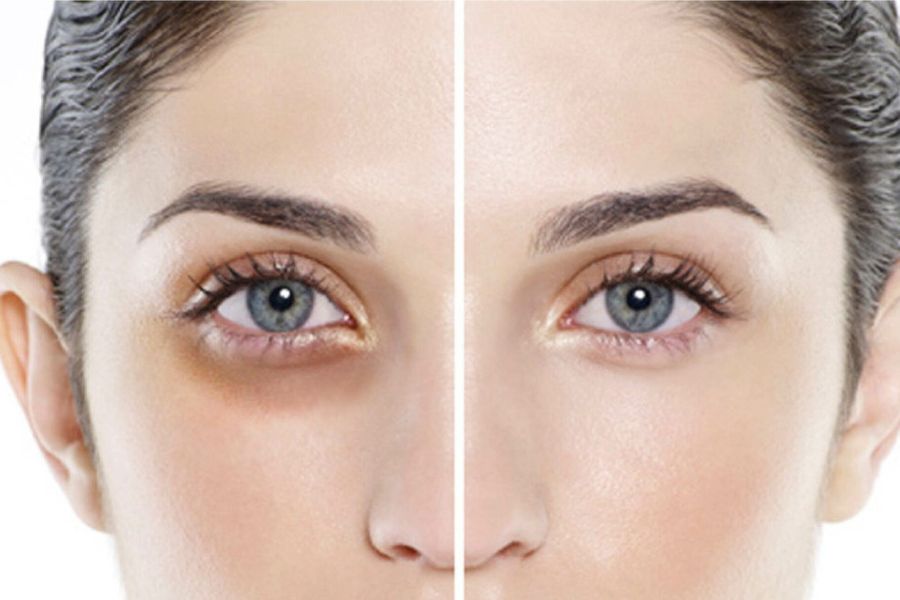 Công nghệ laser giúp nâng cơ mắt không xâm lấn hiệu quả