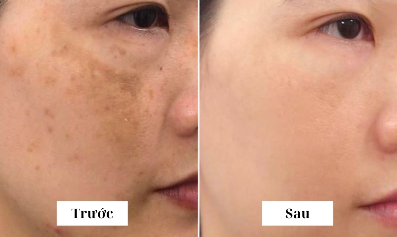 Kem đặc trị nám giúp cải thiện tình trạng tăng sắc tố, làm sáng da rõ rệt