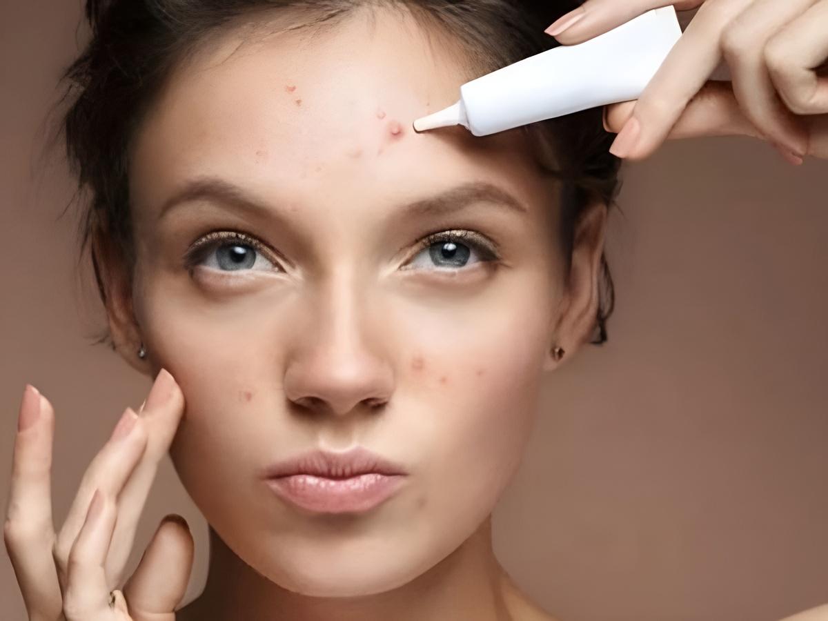 Hình ảnh lọ serum đặc trị mụn, hướng dẫn cách dùng hoạt chất trị mụn an toàn cho người mới bắt đầu