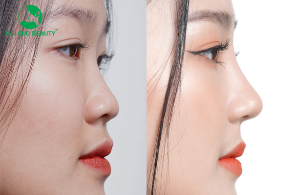 Bảng so sánh đặc tính và tuổi thọ giữa các loại sụn trong phẫu thuật độn cằm.