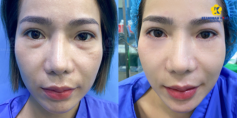 Quy trình chăm sóc hậu phẫu chuẩn y khoa giúp khách hàng Bóc mỡ mắt mí dưới