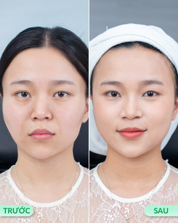 Bác sĩ đang thực hiện quy trình tiêm filler đảm bảo an toàn y khoa.