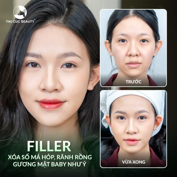 Minh họa quy trình tiêm filler an toàn tại cơ sở uy tín để bảo vệ sức khỏe.