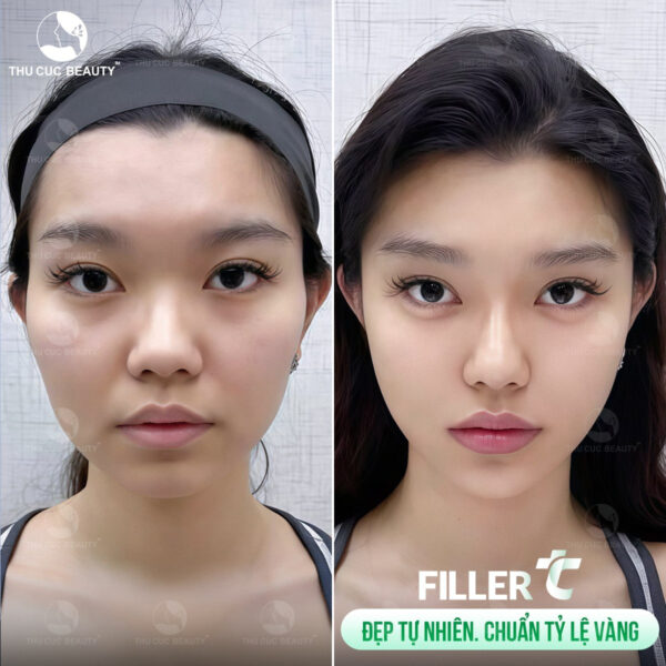 Bác sĩ kiểm tra vùng rãnh cười trước khi tiến hành tiêm filler chuẩn y khoa