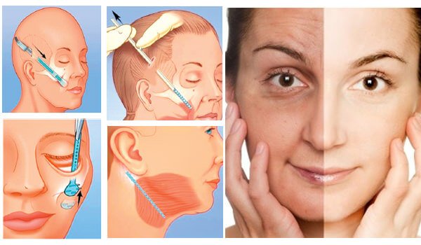 Quy trình chi tiết phẫu thuật căng da mặt và chi phí thẩm mỹ chuẩn y khoa
