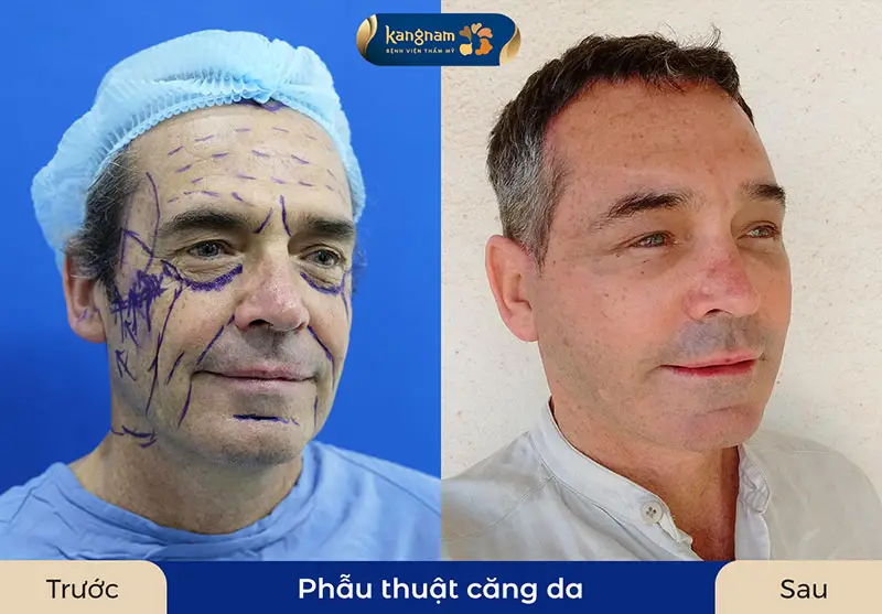 Phẫu thuật căng da mặt giúp khắc phục tình trạng da lão hóa, chảy xệ để duy trì vẻ ngoài tươi trẻ và tự tin